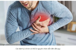 Đột quỵ và những điều cần biết
